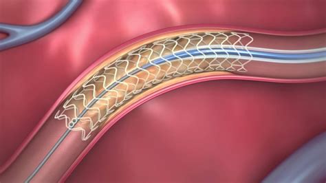 fda approved dissolving heart stent   works youtube