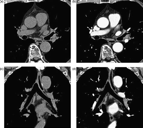 Detection Of Mediastinal And Hilar Lymph Nodes By 16 Row Mdct Is