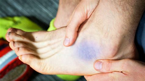 ankle sprain treatment      degree sprains