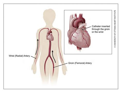Angiogram Cardiac Catheterization Ottawa Heart Institute