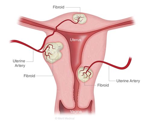 Uterine Fibroids Savannah Vascular Institute