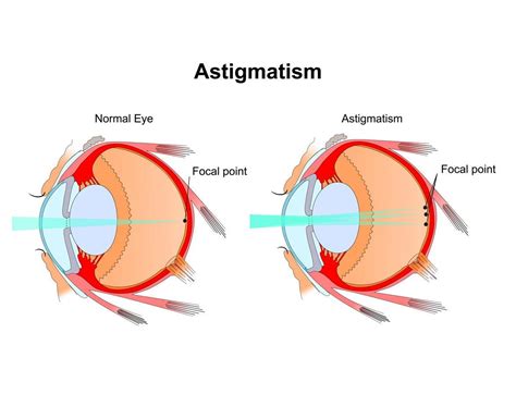 astigmatism faqs