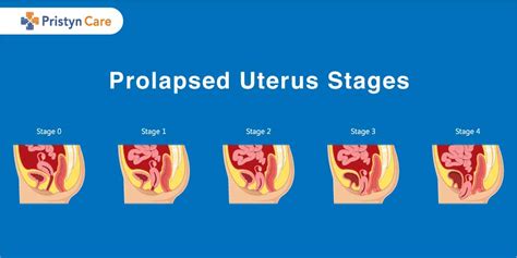 uterine prolapse uterus vagina pelvic floor muscles bladder patient