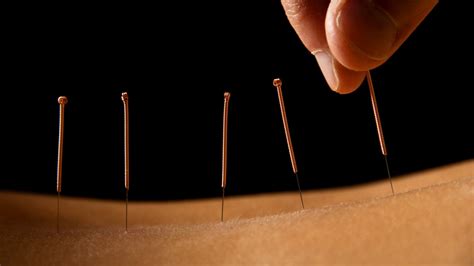 Apakah Akupunktur Aman Untuk Dilakukan Simak Ulasan Berikut