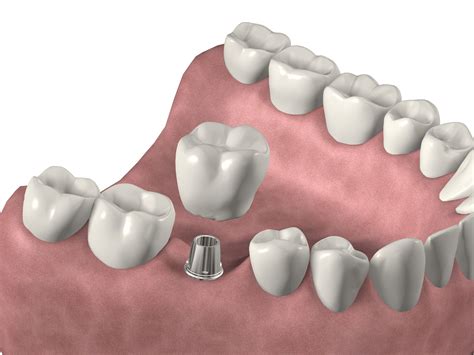 Implante Unitario Cementado Implantes Dentales Implante Dental