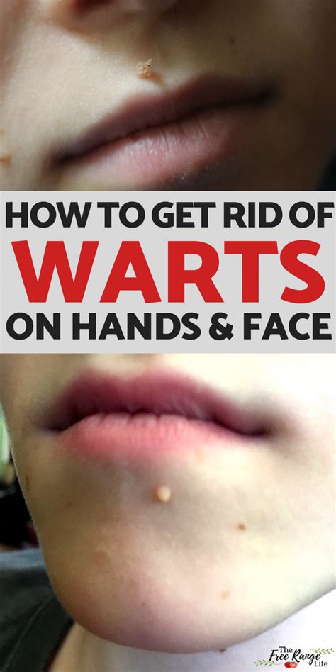 pin on skin warts symptoms