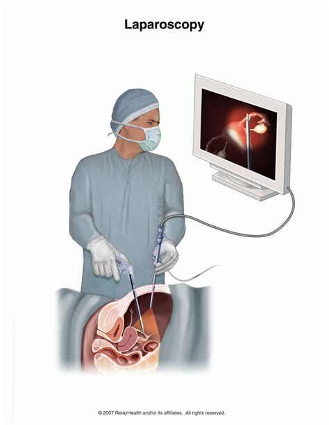 hysterectomy laparoscopic discharge causes symptoms