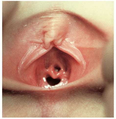 pediatric labia vulva adhesions