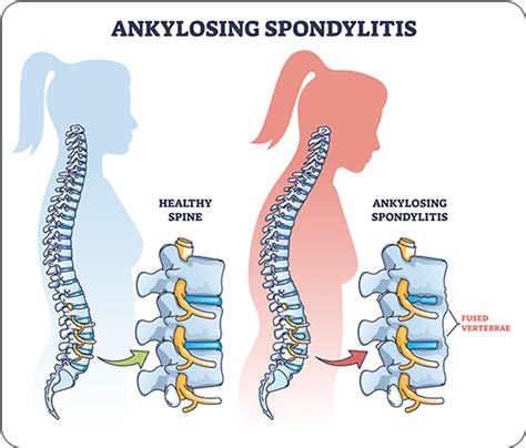 ankylosing spondylitis nurses revision