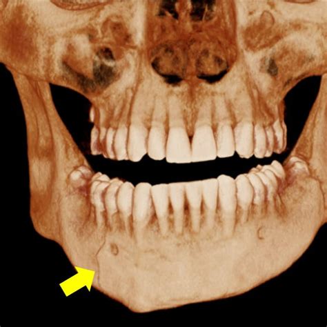 fractura mandibular multiple dento metric radiologia dental oral