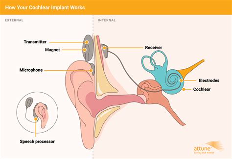 cochlear implants attune