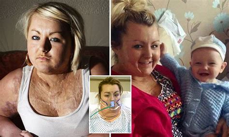 Woman Says She Wanted To Die After Suffering Horrific Burns To 80 Of