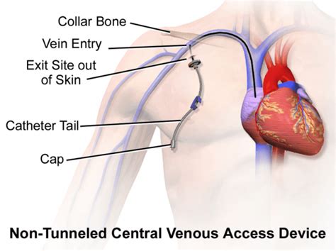 central venous catheter cvc and it s placement