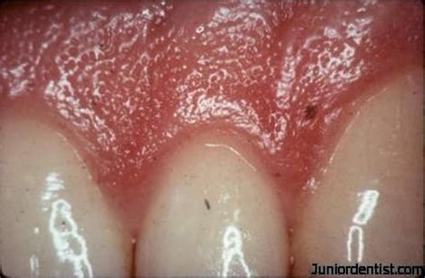 dentest gingiva