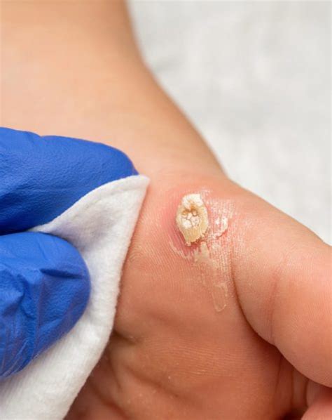 plantar warts southernmost foot and ankle specialists