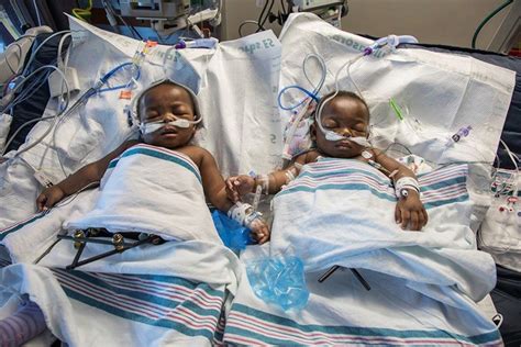 Beautiful New Photo Of Former Conjoined Nigerian Twins