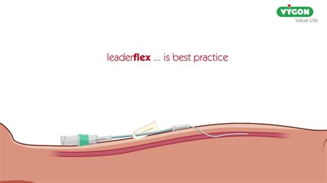 leaderflex insertion technique youtube