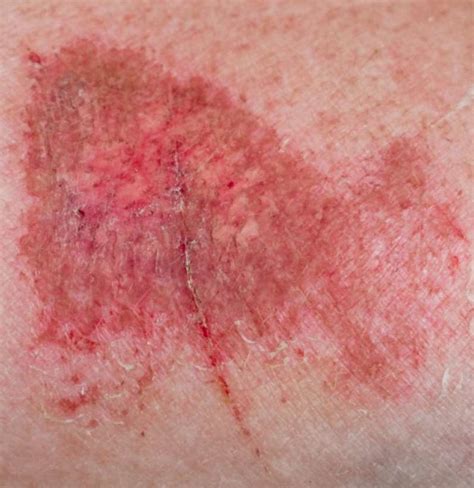 Friction Burn On Penis Symptoms Treatment And Prevention