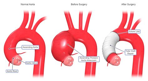 thoracic aortic aneurysm repair