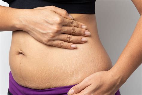 pregnancy stretch marks causes prevention and treatment today paper