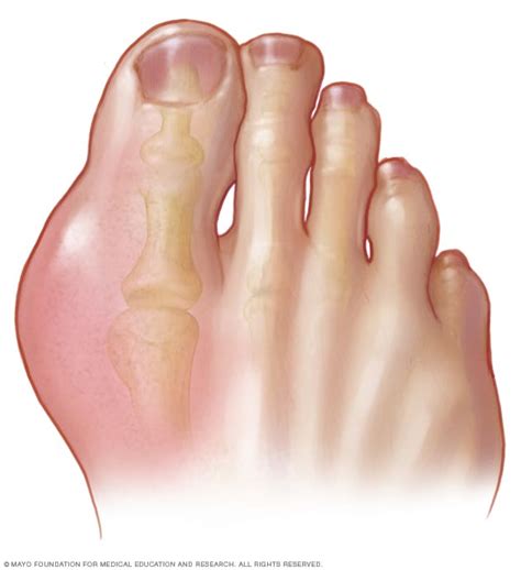 gout symptoms   mayo clinic