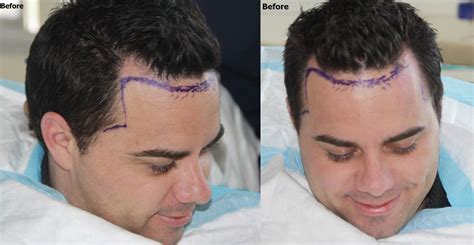 hairline lowering  temple closure hair restoration alviarmani