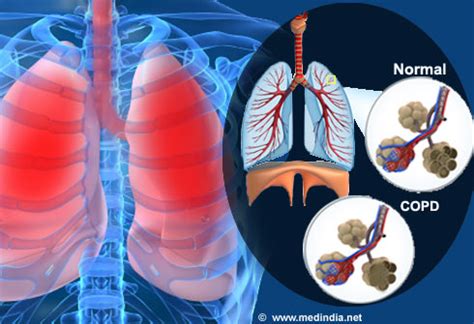 diet  obstructive lung disease slideshow