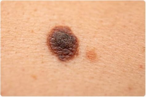 melanoma dermatology conditions  treatments