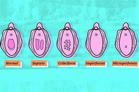 Types Of Hymen That We Didnt Know Existed