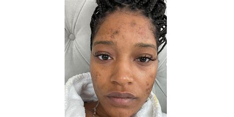 Keke Palmer Gets Candid About Her Battle With Polycystic Ovary Syndrome