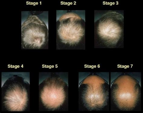 Hair Loss Explained How And Why Men Go Bald The Independent