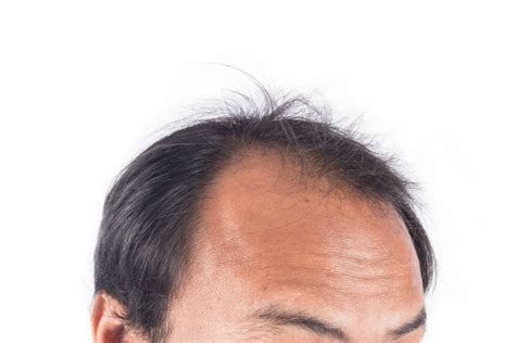 Male Pattern Baldness Treatment Cure And Stop Hair Loss In Men