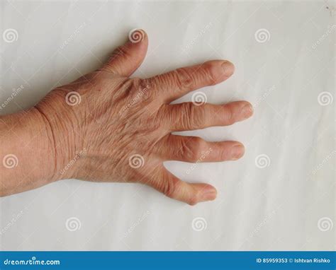 doigts deformes sur la main de dame agee image stock image du fond medical