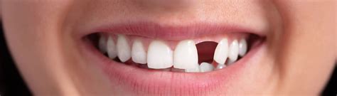 single  multiple missing teeth dunedin fl replacing options