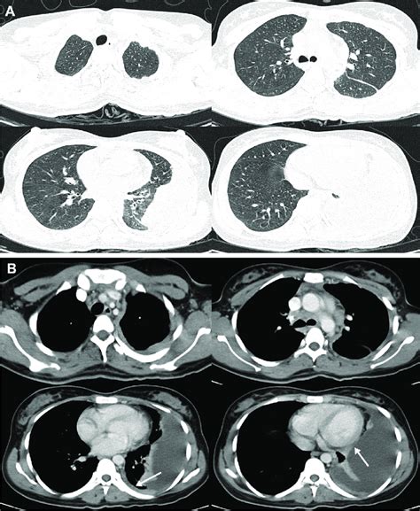 A Ct Chest Lung Window Showing No Evidence Of Consolidation