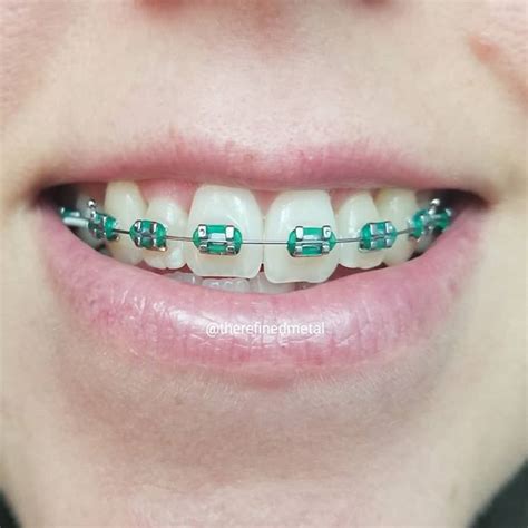 Best Teal Braces – Braces Explained