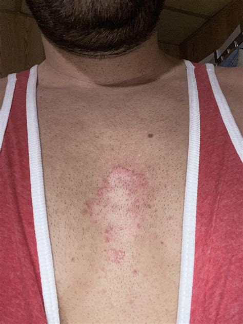 itchy bumps  chest