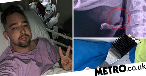 Man Got Wire Bristle From Bbq Brush Stuck In Throat After