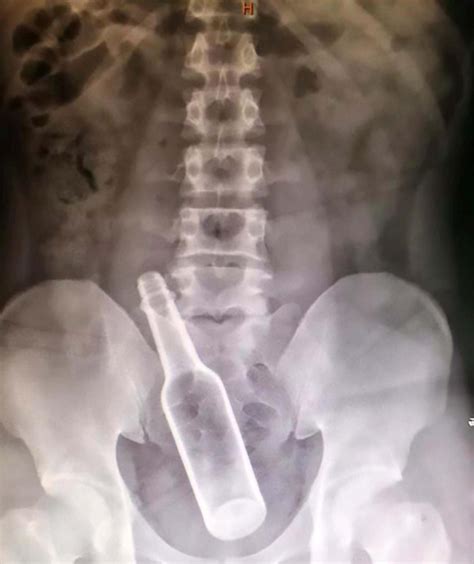 Chinese Man Undergoes Surgery To Remove Bottle From Rectum After