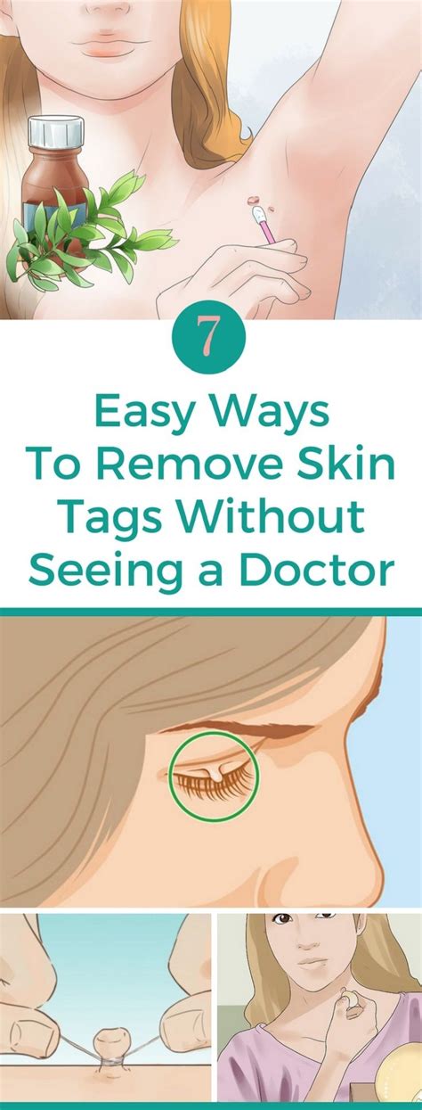 7 easy ways to remove skin tags without seeing a doctor skin tag removal health natural