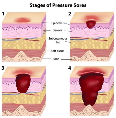 stage  pressure ulcer