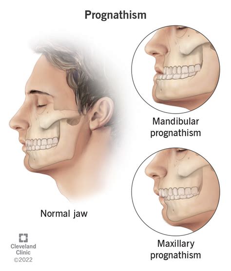 prognathism definition  treatment