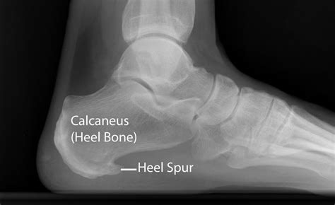 Plantar Fasciitis And Bone Spurs Orthoinfo Aaos