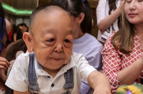 Tragic Tot S Condition Makes Him Look Like Wrinkled Old Man Just Like