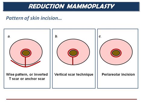 mastectomy incision types