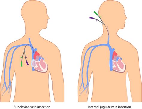 study medical  central venous  catheter related infections