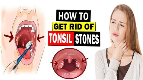rid  tonsil stones naturally home remedies  tonsil