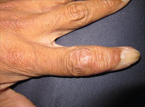 subcutaneous nodules   fingersquiz case dermatology jama