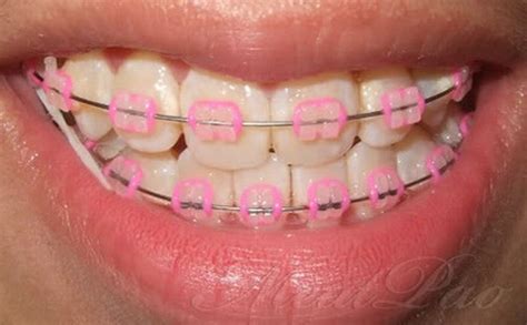 clear pink braces colors braces pinterest pink braces and braces