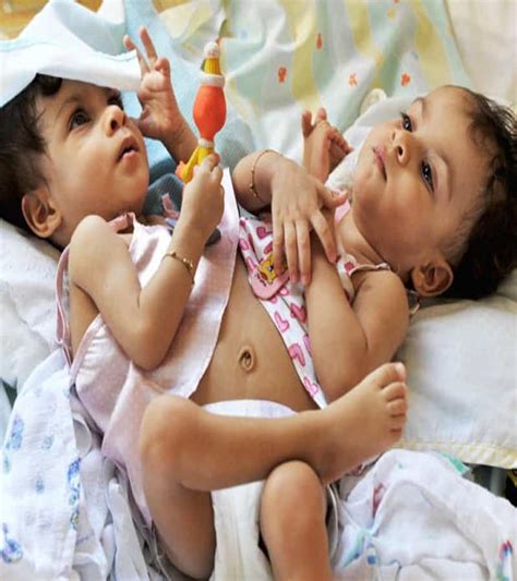 12 Insane Photos Of Conjoined Twins